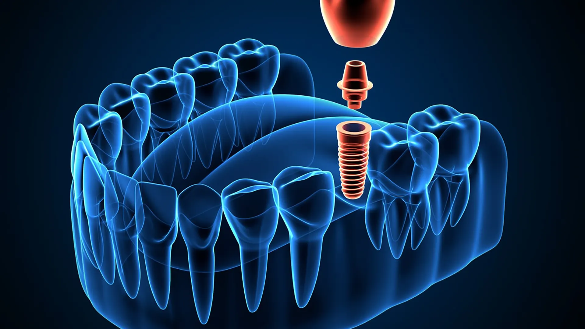 impianto denti chirurgia 3D